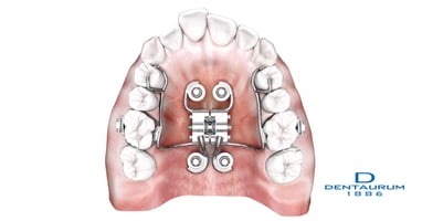 Palatal expansion using the MARPE appliance