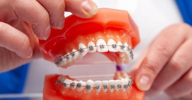 orthodontic brackets