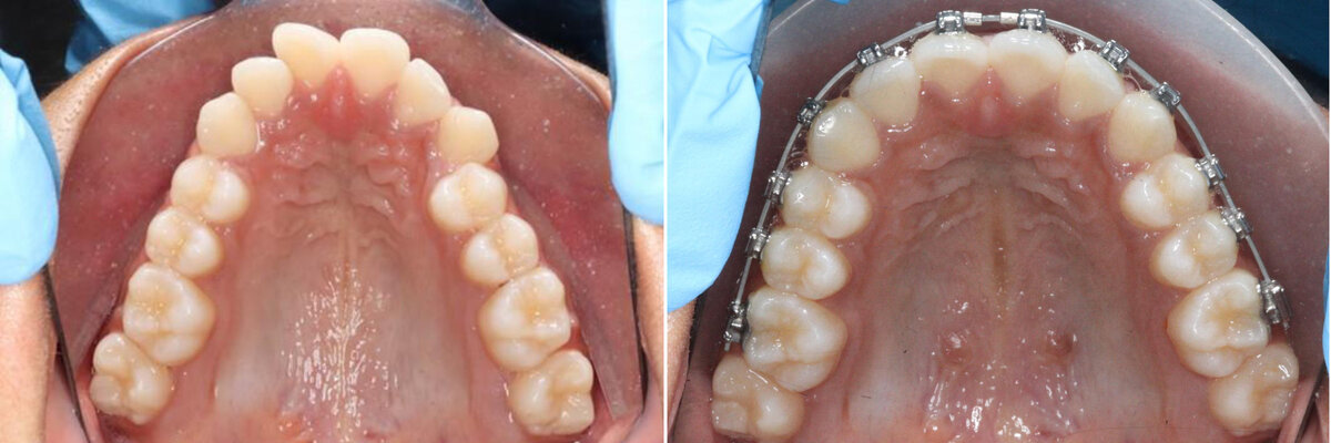 Before and after treatment. Image courtesy Dr Simanto Purkayastha.