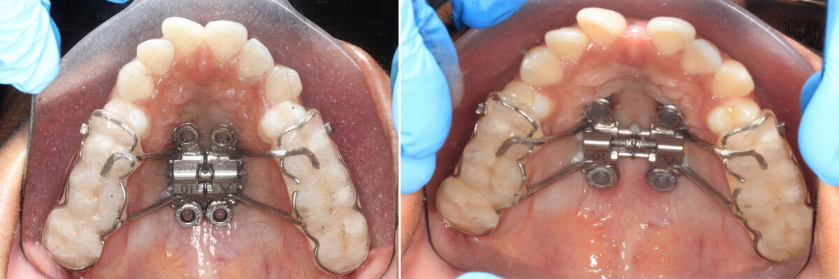 Insertion of MARPE Appliance