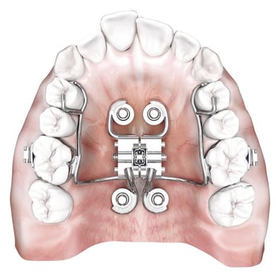 Palatal expansion using the MARPE appliance