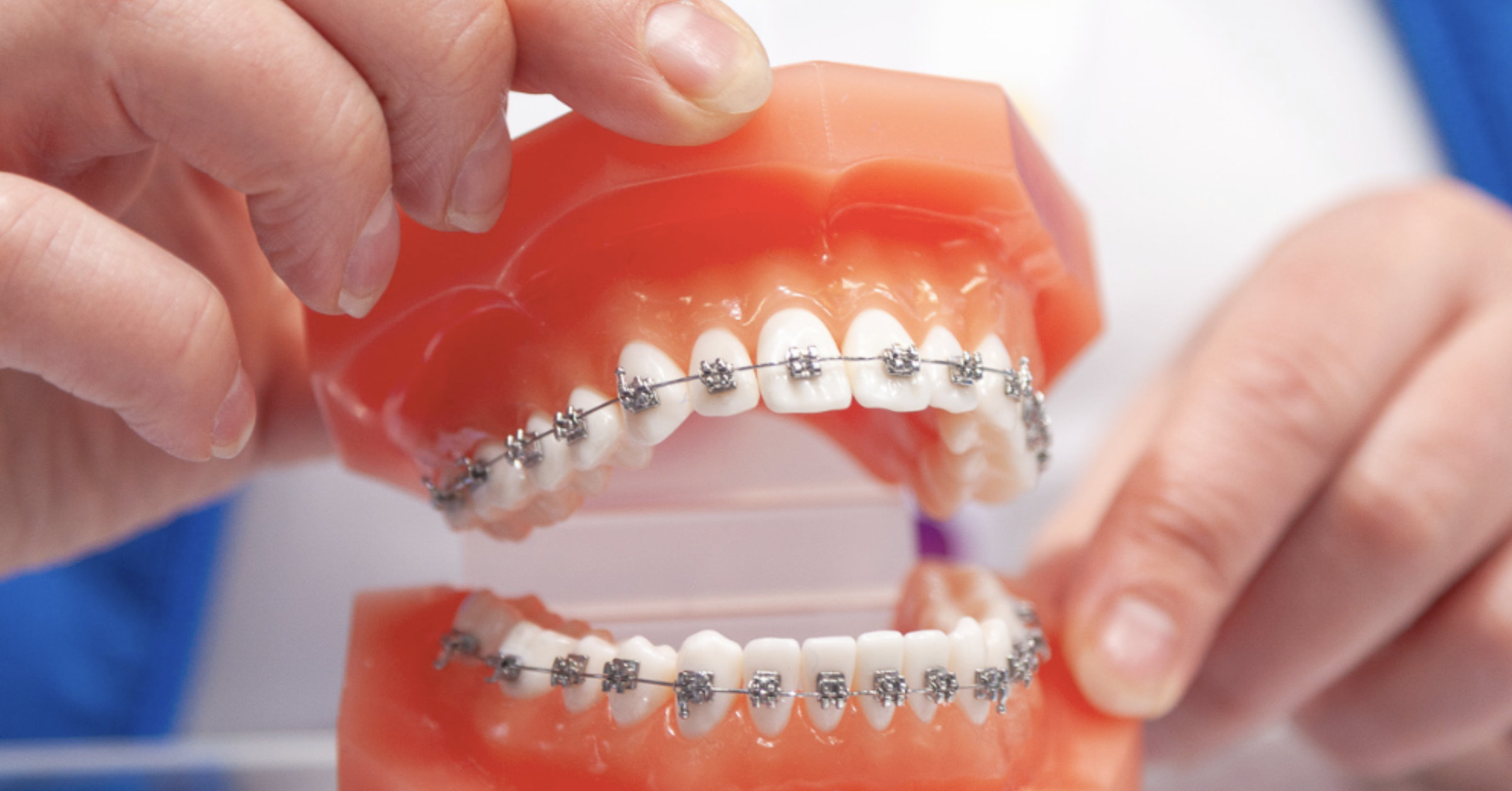 orthodontic brackets