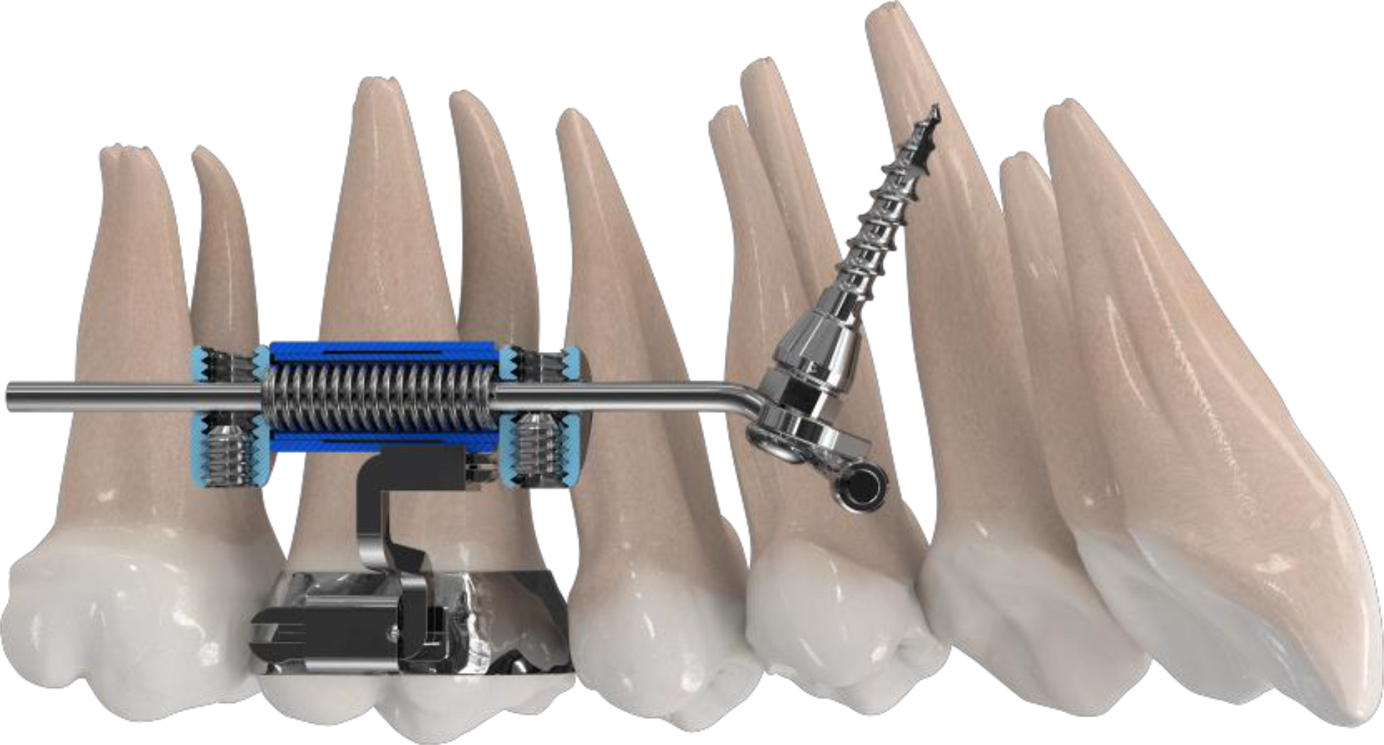 amda®. The advanced molar distalization appliance